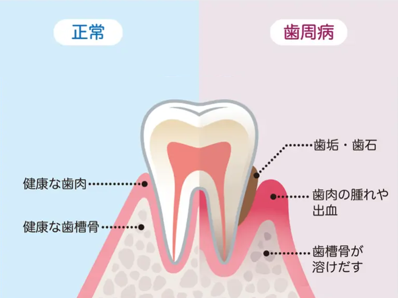 歯周病の治療／歯周病の予防